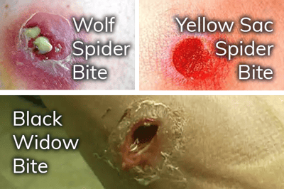 Image showing how a wolf spider bite, yellow sac spider bite and black widow bite look like