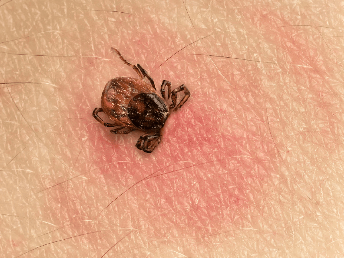tick bite on skin